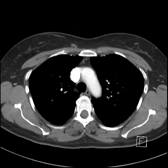 Breast metastases from renal cell cancer (Radiopaedia 79220-92225 A 29).jpg