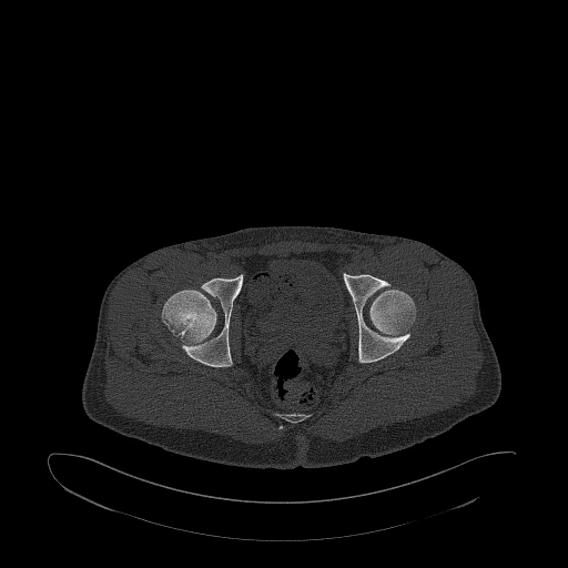 Brodie abscess- femoral neck (Radiopaedia 53862-59966 Axial bone window 139).jpg