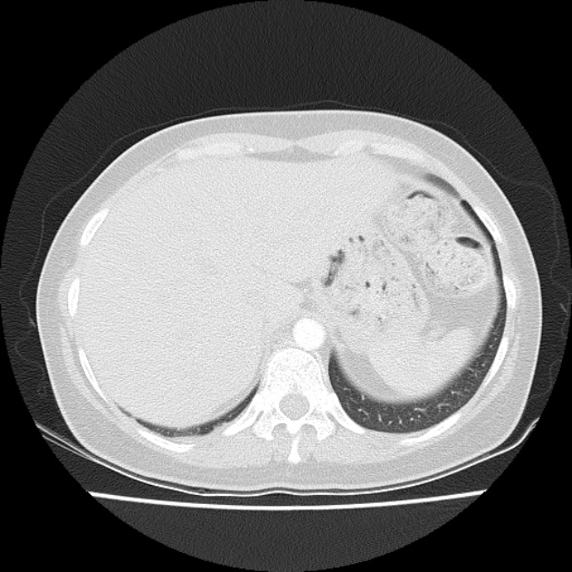 Bronchial atresia (Radiopaedia 22965-22992 Axial lung window 8).jpg