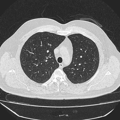 File:Bronchial atresia (Radiopaedia 58271-65417 Axial lung window 13).jpg