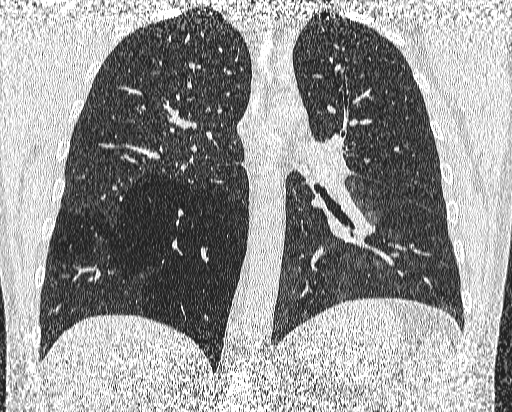 Bronchial atresia (Radiopaedia 58271-65417 Coronal lung window 35).jpg