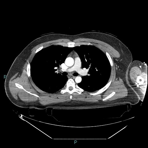 Bronchial carcinoid tumor (Radiopaedia 78272-90870 B 52).jpg