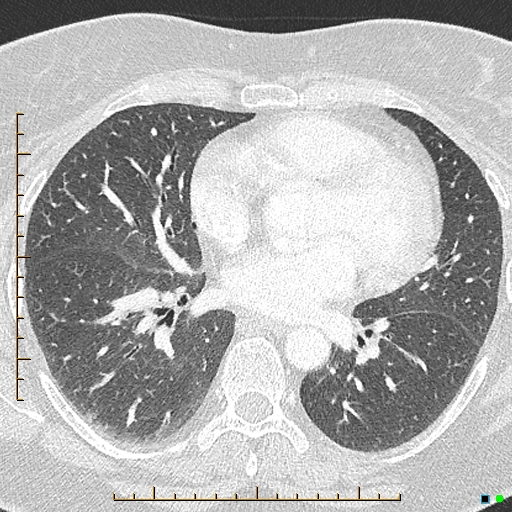 Bronchial diverticula (Radiopaedia 79512-92676 Axial lung window 112).jpg