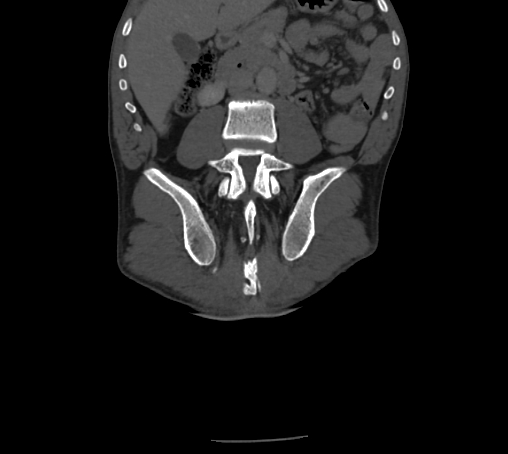 Bronchiectasis in Crohn disease (Radiopaedia 60311-67977 Coronal bone window 54).jpg
