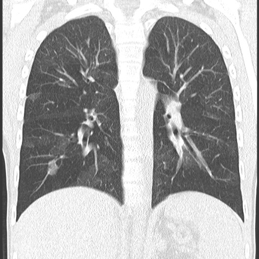 File:Bronchiolotis obliterans (Radiopaedia 73769-84575 Coronal lung window 24).jpg