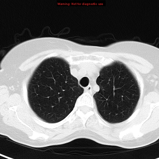 File:Bronchoalveolar carcinoma (BAC) (Radiopaedia 13436-13392 Axial lung window 10).jpg