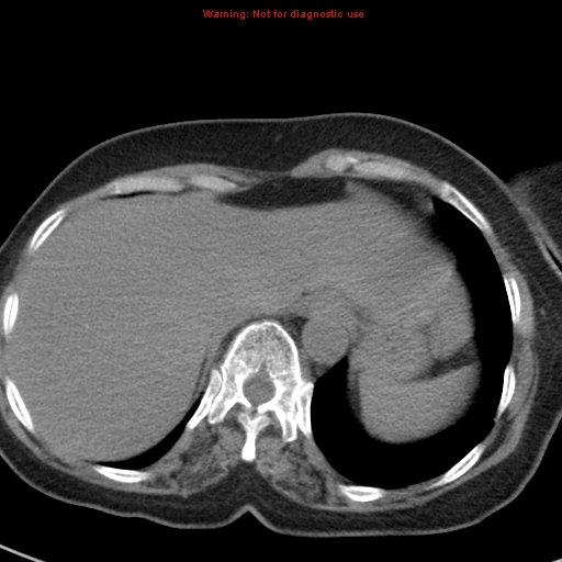 File:Bronchoalveolar carcinoma (BAC) (Radiopaedia 13436-13392 Axial non-contrast 44).jpg