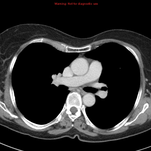 File:Bronchoalveolar carcinoma (BAC) (Radiopaedia 13436-13392 B 25).jpg