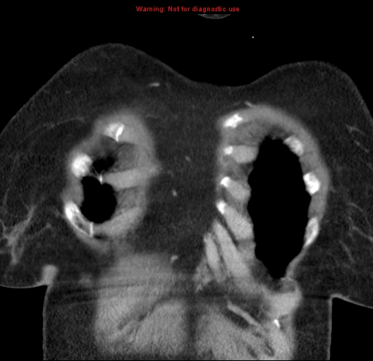 Bronchoalveolar carcinoma (BAC) (Radiopaedia 13436-13392 E 6).jpg