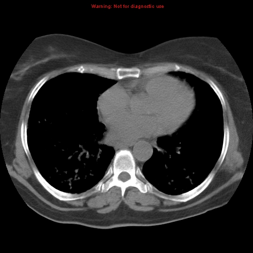 Bronchoalveolar carcinoma (Radiopaedia 13224-13233 Axial non-contrast 28).jpg