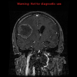 File:Bronchogenic carcinoma brain metastasis (Radiopaedia 9286-9969 Coronal T1 17).jpg