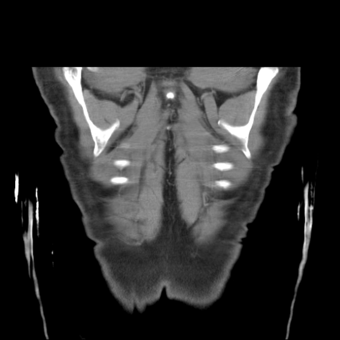 Bronchogenic carcinoma with upper lobe collapse (Radiopaedia 29297-29726 D 54).jpg