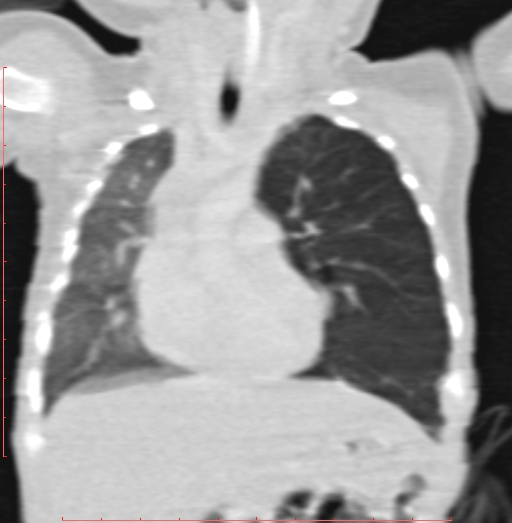 Bronchogenic cyst (Radiopaedia 78599-91409 Coronal lung window 98).jpg