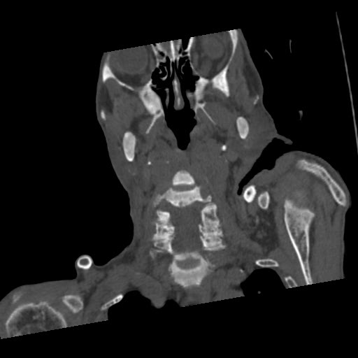 File:Brown tumor with secondary hyperparathyroidism (Radiopaedia 23591-23705 C 35).jpg