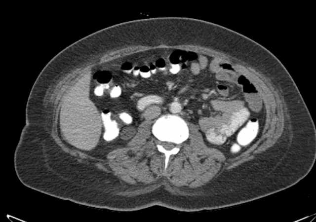 Brown tumors compressing the spinal cord (Radiopaedia 68442-77988 E 58).jpg