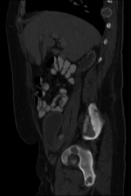 Brown tumors compressing the spinal cord (Radiopaedia 68442-77988 H 20).jpg