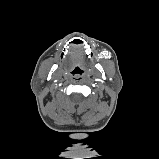 Buccal fat pad arteriovenous malformation (Radiopaedia 70936-81144 D 193).jpg