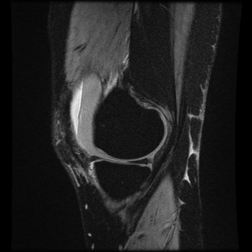 Bucket handle meniscus tear (Radiopaedia 56916-63751 H 65).jpg
