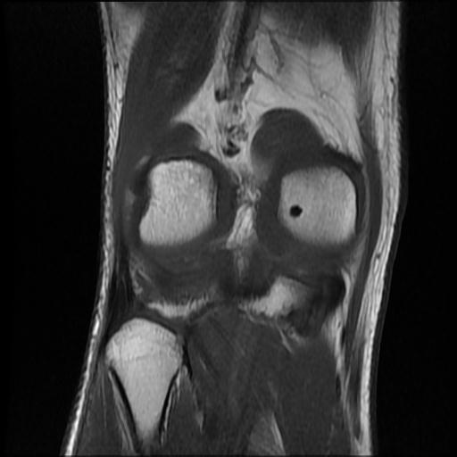 File:Bucket handle tear - medial meniscus (Radiopaedia 69245-79026 Coronal T1 16).jpg