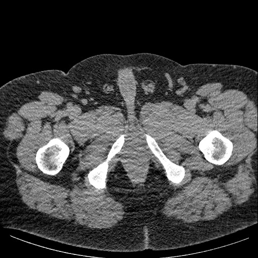 Burned-out testicular seminoma - retroperitoneal nodal metastases (Radiopaedia 62872-71245 A 76).jpg