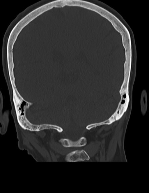 Burnt-out meningioma (Radiopaedia 51557-57337 Coronal bone window 37).jpg