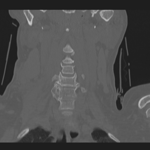 C2 fracture (Radiopaedia 34091-35341 Coronal bone window 15).png