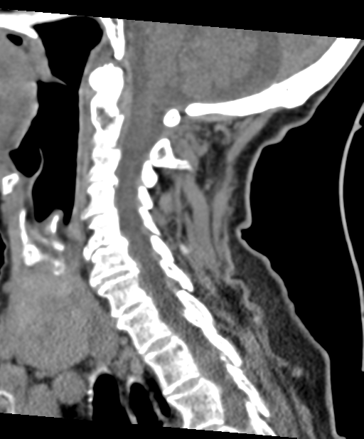 C2 fracture with vertebral artery dissection (Radiopaedia 37378-39199 D 44).png