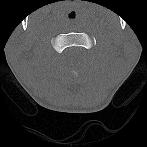 File:C5 facet fracture (Radiopaedia 58374-65499 Axial bone window 21).jpg