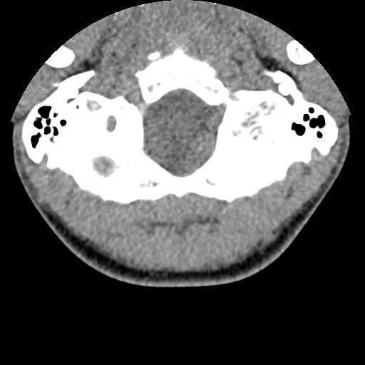 C5 facet fracture (Radiopaedia 58374-65499 Axial non-contrast 5).jpg