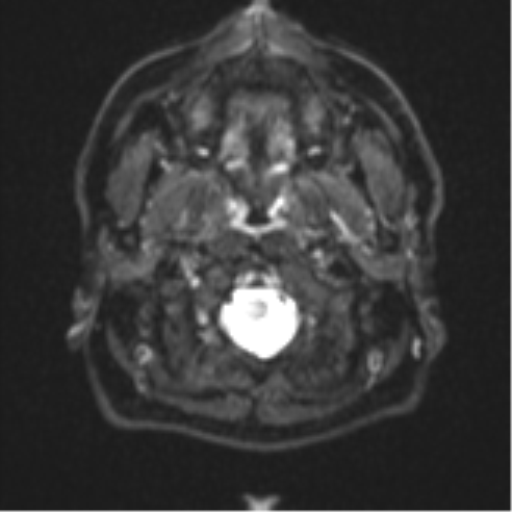 File:CNS vasculitis (Radiopaedia 55715-62263 Axial DWI 1).png