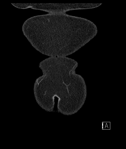 Calcified adrenal glands and Spigelian hernia (Radiopaedia 49741-54988 B 4).jpg