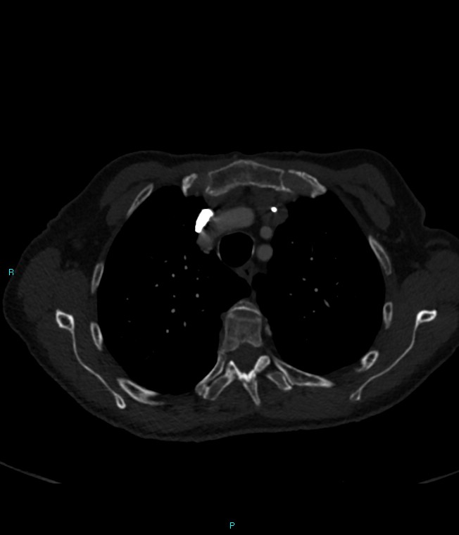 Calcified cerebral emboli from left ventricular thrombus (Radiopaedia 84420-99760 Axial bone window 18).jpg