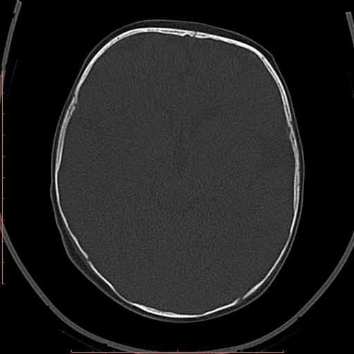 Calcified middle cerebral artery embolism (Radiopaedia 78949-91860 Axial bone window 28).jpg