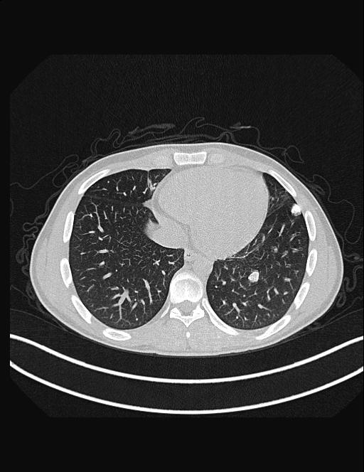 Calcifying pulmonary metastases (Radiopaedia 33359-34396 Axial lung window 46).jpg