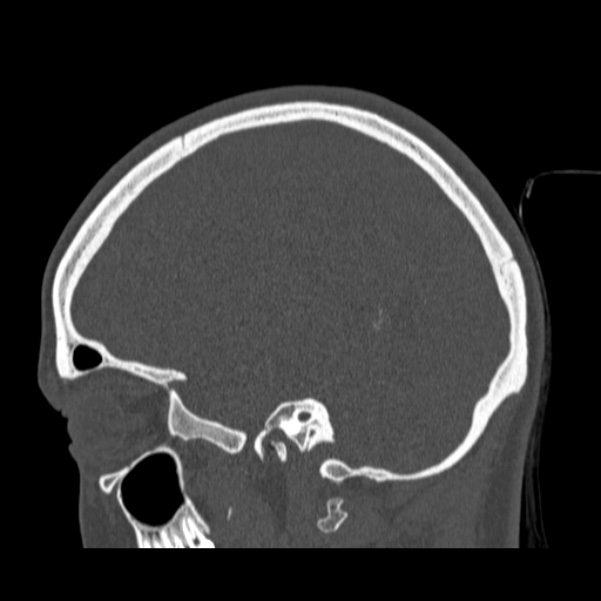 Calvarial osteoma (Radiopaedia 36520-38079 Sagittal bone window 73).jpg