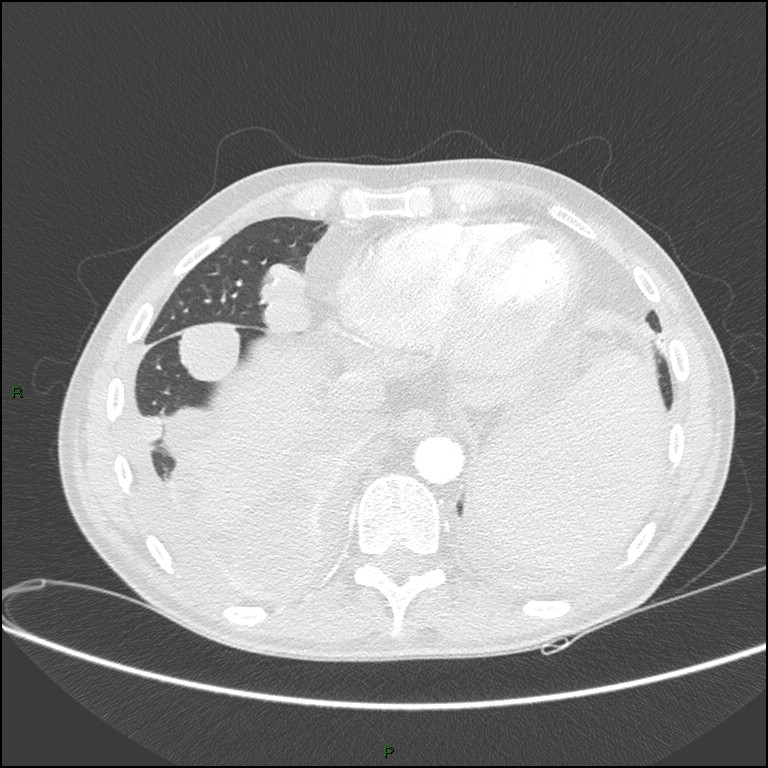 Cannonball metastases (Radiopaedia 82110-96150 Axial lung window 149).jpg