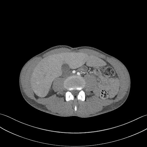 File:Cannonball metastases - testicular choriocarcinoma (Radiopaedia 84510-99891 B 143).jpg