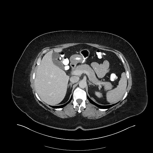 Carcinoid tumor - terminal ileum (Radiopaedia 60931-68739 A 38).jpg