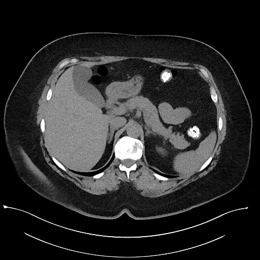 Carcinoid tumor - terminal ileum (Radiopaedia 60931-68740 Axial non-contrast 25).jpg