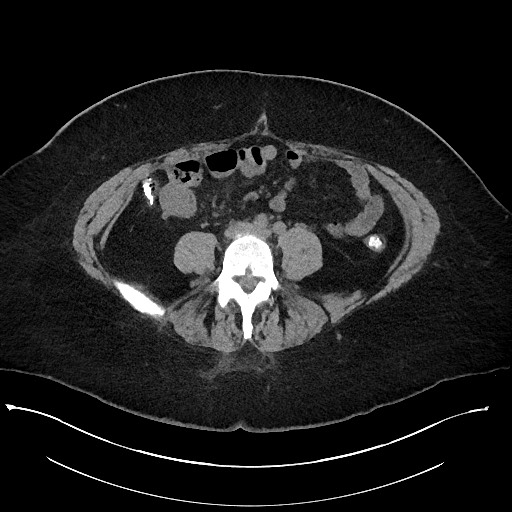 Carcinoid tumor - terminal ileum (Radiopaedia 60931-68740 Axial non-contrast 73).jpg