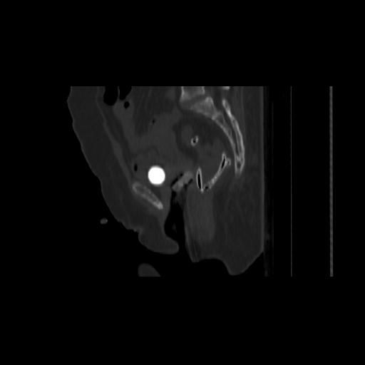 Carcinoma cervix- brachytherapy applicator (Radiopaedia 33135-34173 Sagittal bone window 102).jpg