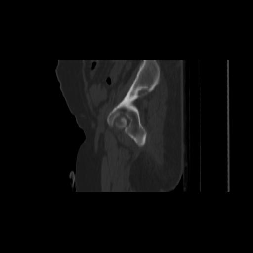 File:Carcinoma cervix- brachytherapy applicator (Radiopaedia 33135-34173 Sagittal bone window 22).jpg