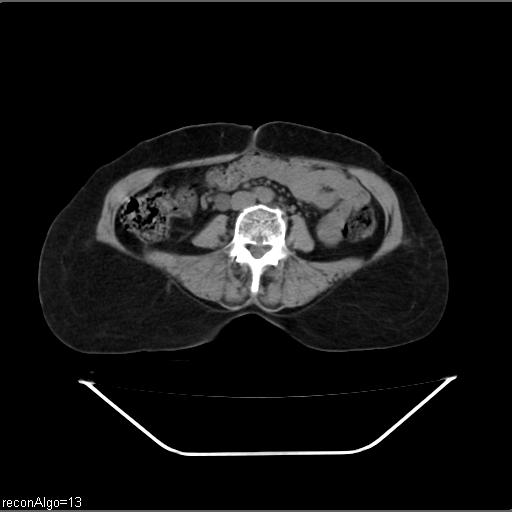 File:Carcinoma cervix- recurrence (Radiopaedia 34702-36137 Axial non-contrast 31).jpg