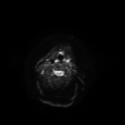 Carcinoma ex-pleomorphic adenoma of parotid (Radiopaedia 28383-28627 Ax DWI B-500 GE 4).jpg