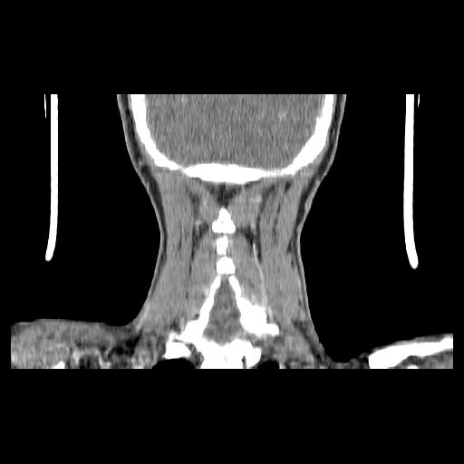 Carcinoma of the maxillary antrum (Radiopaedia 53805-59888 Coronal C+ delayed 138).jpg