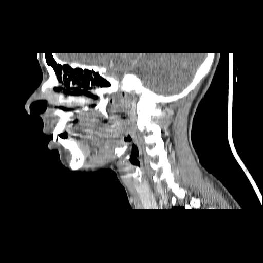 Carcinoma of the maxillary antrum (Radiopaedia 53805-59888 Sagittal C+ delayed 113).jpg