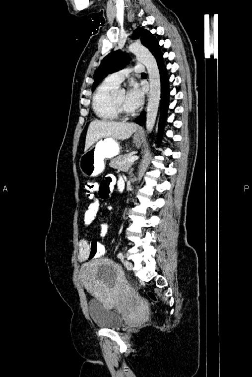 Carcinoma of uterine cervix (Radiopaedia 85861-101700 D 49).jpg