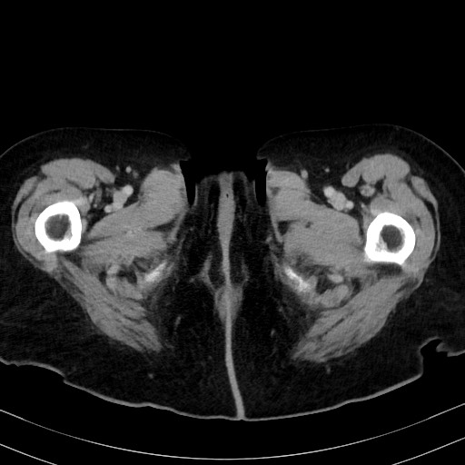 Carcinosarcoma (Radiopaedia 70401-80503 A 78).jpg