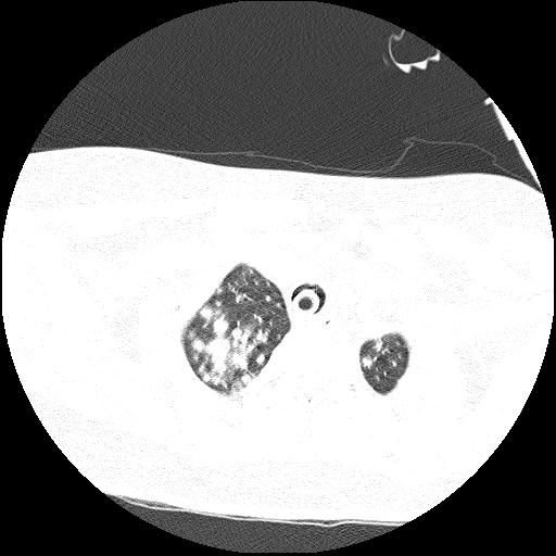 File:Cardiac angiosarcoma (Radiopaedia 66010-75181 Axial lung window 81).jpg