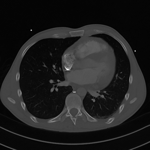 Cardiac tumor - undifferentiated pleomorphic sarcoma (Radiopaedia 45844-50134 Axial bone window 40).png